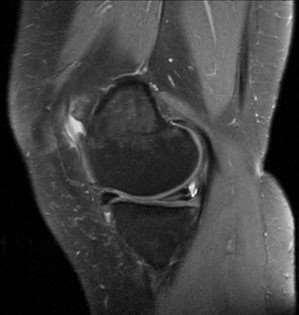 2. Padrões de ruptura Critérios de ruptura meniscal: - Morfologia anormal ( cirurgia anterior); - Hipersinal