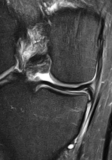 2. Padrões de ruptura Flap vertical/horizontal - RM: identificação de