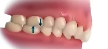 Problemas mais comuns OVERJET Dentes anteriores e superiores se