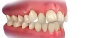 DESALINHAMENTO TOTAL Dentes superiores e/ou inferiores desalinhados.