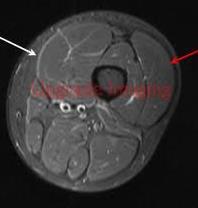 Musculatura anterior da coxa m. psoas m.