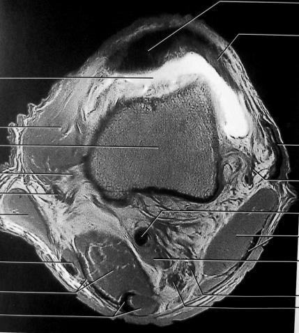 semitendinoso Retinaculo lateral