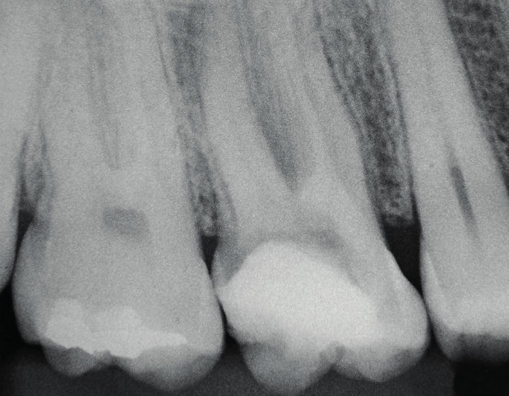 Endodontia RELEVÂNCIA CLÍNICA Conceitos aplicados, técnicas de preparo para retentor e cimentação de pinos intra-radiculares de fibra de vidro a partir de um diagnóstico e planejamento