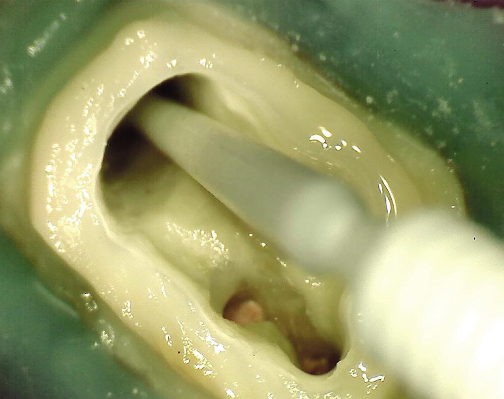 VALDIVIA JE; MACHADO MEL FIGURA 7 Aplicação de adesivo dentinário auto-condicionante (Futura Bond U, Voco, GmbH, Cuxhaven, Alemanha) no interior do conduto radicular, observa-se a introdução do