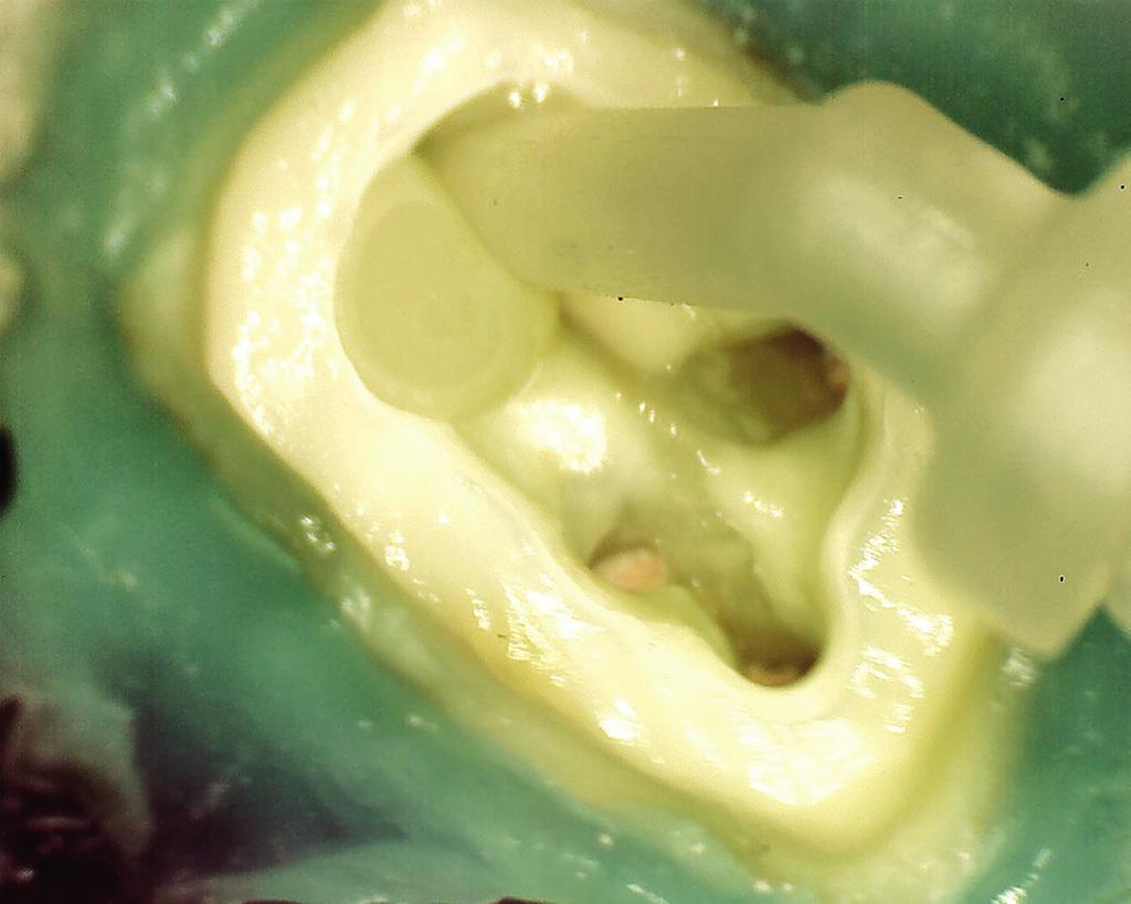 Endodontia FIGURA 10 Inserção do cimento resinoso dual no interior do canal radicular com pontas aplicadoras (Allcem Core, FGM, Joinville SC, Brasil) FIGURA 11 Radiografia final, blindagem