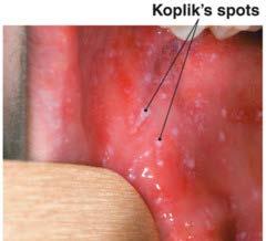 Pródromos de 1-6 dias: febre, mal estar, prostração, tosse e coriza surgimento das manchas de Koplik (patognomônicas): lesões puntiformes e esbranquiçadas na mucosa oral, região jugal 1-3 dias depois