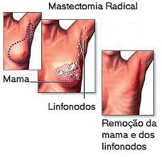Reconstruções Mamárias Mundialmente, o CA mama é o mais prevalente e comum entre as mulheres Embora o tratamento para o CA de mama tenha melhorado.