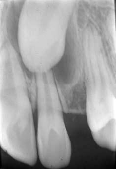 822 Orthodontic Sci. Pract. 2011; 4(16): 819-826 Figura 3 - Telerradiografia de norma lateral da face.