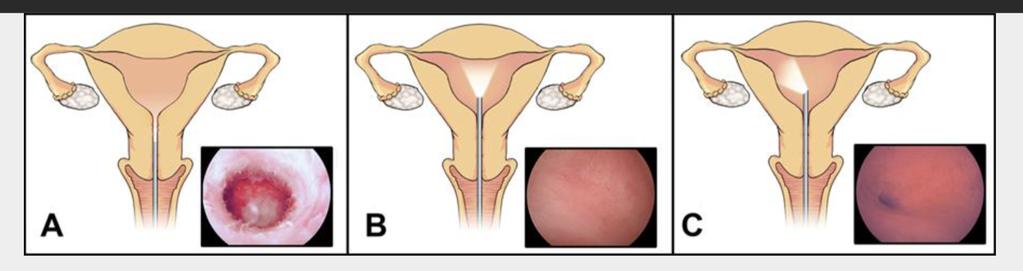 uterina anormal, anormalidades müllerianas, infertilidade e abortos repetidos, localização de corpos estranhos, diagnóstico e tratamento de lesões benignas, entre outras.