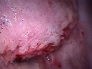 Fig. 24 - EAB denso, sobrelevado, com