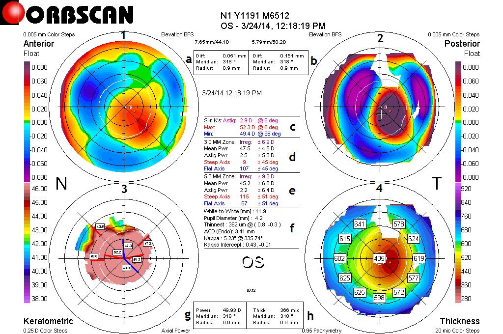 Figura 10: Orbscan do OE do dia 24 de Março após cirurgia.