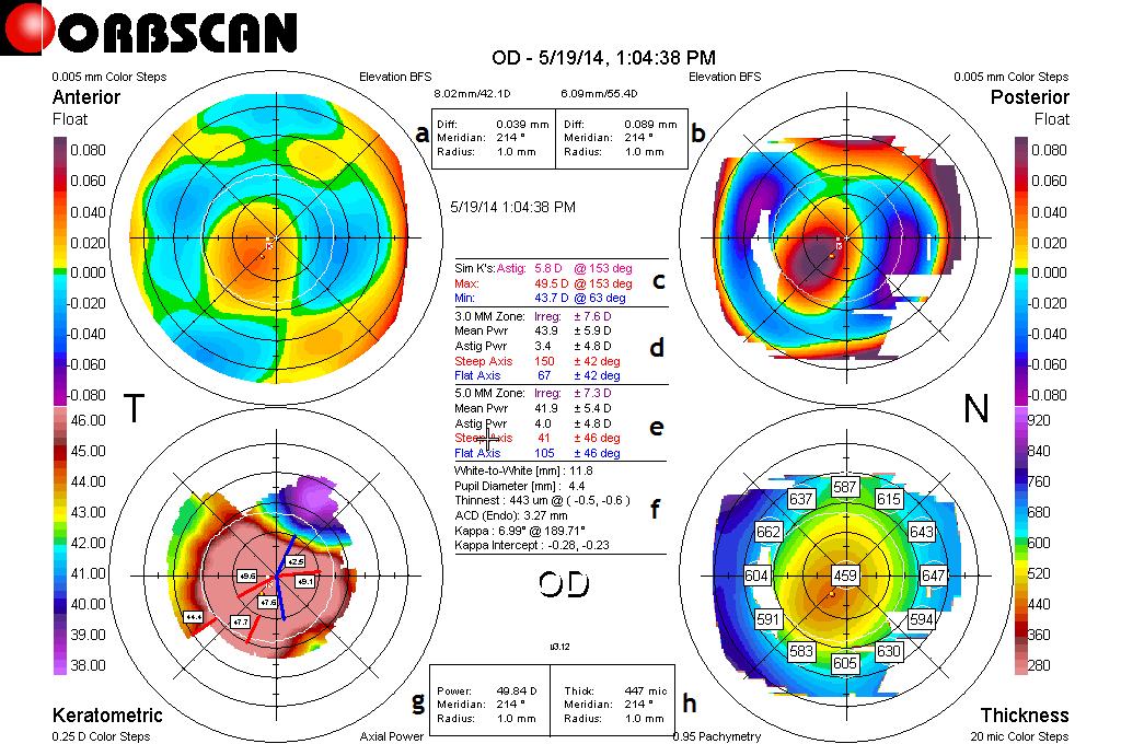 Figura 11: Orbscan do OD do dia 19 de Maio após cirurgia.