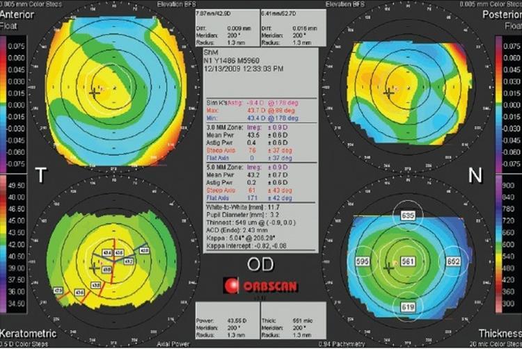 Figura 1- Orbscan de um olho direito normal. Os quatro mapas no sentido horário, a partir do canto superior esquerdo incluem a elevação anterior, a elevação posterior, paquimetria e poder axial.