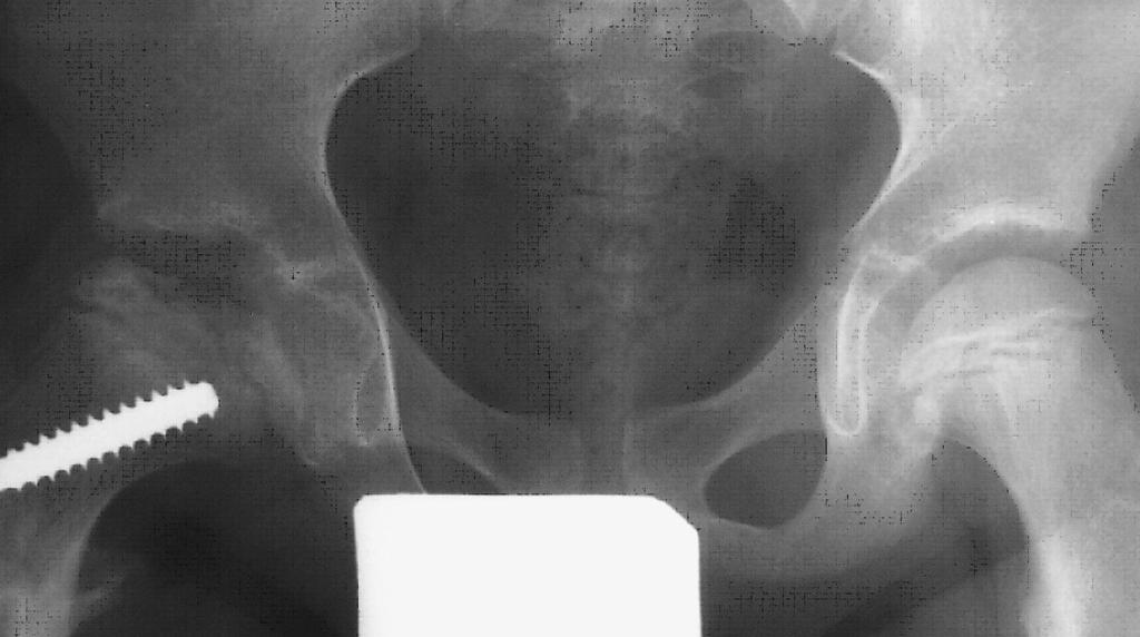 Um sinal característico desta etapa é a presença de uma linha hipertransparente paralela à superfície articular conhecida por sinal em crescente e traduz a fractura subcondral (Fig. 2).