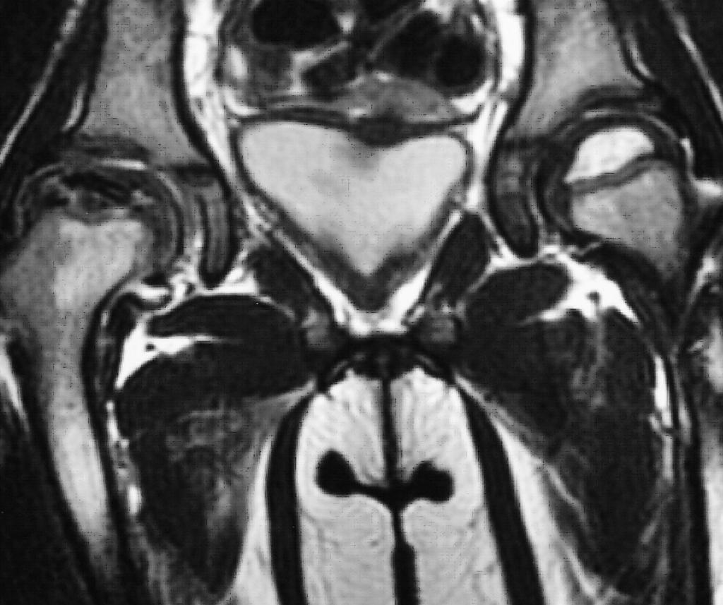 [4,5] Outros sinais imagiológicos também observados na Ressonância Magnética são: derrame articular, perda da esfericidade da cabeça femural e incongruência acetabular (Fig. 10).