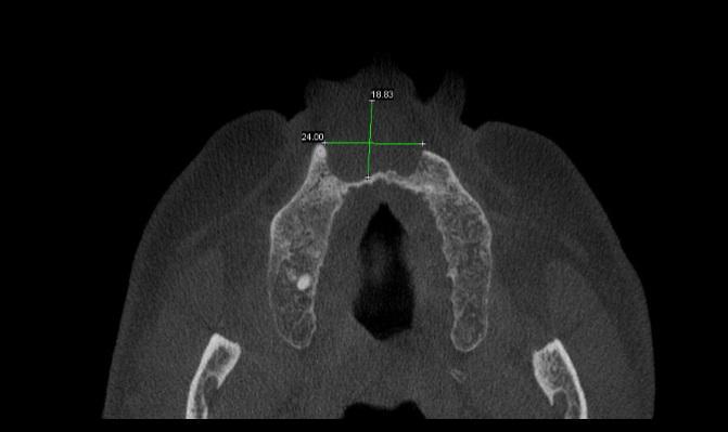 14 Imagem 03 Tomografia Computadorizada Cone Bean da maxila, em corte axial, mostrando imagem sugestiva da lesão na região dos incisivos superiores e destruição do osso