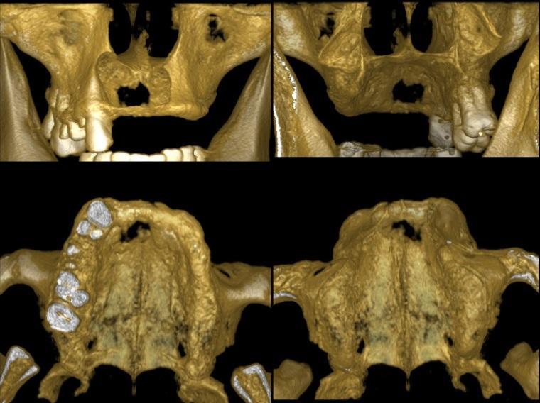 15 Imagem 04 - Tomografia Computadorizada Cone Bean da maxila em uma reconstrução tridimensional mostrando imagem sugestiva de destruição óssea da lesão na região dos incisivos superiores.