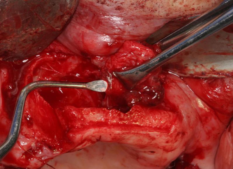 16 ostectomia periférica com broca de desgaste e cauterização química com solução de Carnoy por 5 minutos. Imagem 05 Fotografia trans-operatória da ressecção do tumor.