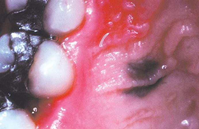 Figura 2 (Livro Patologia Oral e Maxilofacial 3ª edição (2009), cap. 10, p. 384): Nevo melanocítico intramucoso. Lesão pigmentada na região anterior do palato duro (cortesia do Dr. Lewis Claman).