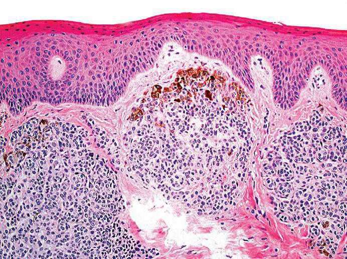 o Nevo intramucoso: Quando há acúmulo de células névicas apenas no tecido conjuntivo (é a manifestação mais frequente).