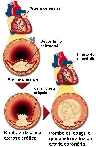 Alguns Distúrbios Cardíacos Infarto do miocárdio Morte de uma área do músculo cardíaco Sintomas: O