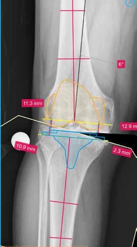 Planear a cirurgia FERRAMENTAS DO JOELHO Auto Knee (Auto-Joelho) fornece um método rápido de efetuar o planeamento da substituição total do joelho para imagens AP e LAT.