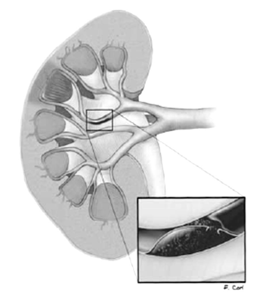 Fig. 5 Laceração parenquimatosa profunda envolvendo o sistema colector. Fig. 6 Trombose arterial de um ramo segmentar da artéria renal. As Fig. 5 e 6 representam lesões renais de grau IV [51].