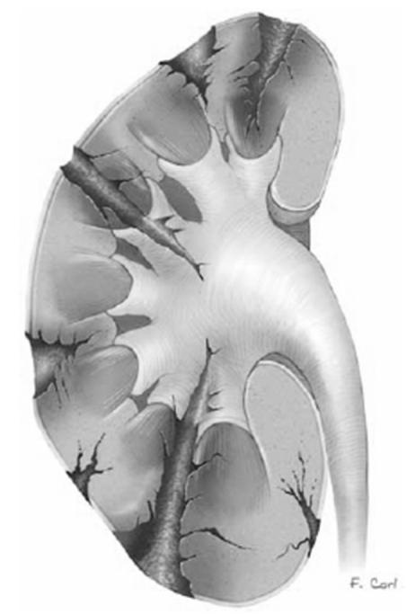 posição anatómica dos rins. Localizam-se no retroperitoneu, Fig. 9 Trombose da artéria renal.