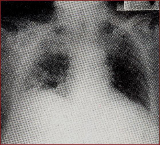 Exames auxiliares de Diagnostico Broncopneumonia observam-se focos