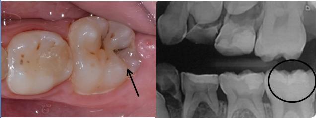 cursos Graduação em Odontolologia da FOA-UNESP (Dente 36, superfície oclusal, código ICDAS 3, lesão inativa).
