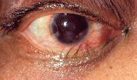 10 Triquíase: alteração na direcção do crescimento dos cílios para dentro, em direcção ao globo ocular; pálpebra inferior ou superior.