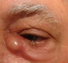 17 Dacriocistite aguda: infecção do saco lacrimal, quase sempre em contexto de obstrução das vias lacrimais.