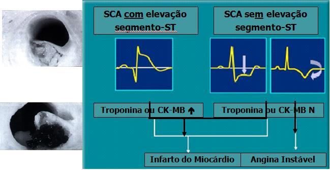 Síndrome Isquêmica