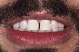 Análise do sorriso O sorriso, também chamado de descortinamento labial, uma alusão à abertura das cortinas de um espetáculo, permite a exposição dos dentes (estética branca) e gengivas