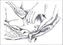 Cuidados com o períneo o A lesão de períneo é um traumatismo frequente durante o parto, mesmo em partos e trabalhos de parto com evolução normal o Manobra de Ritgen: durante a expulsão do polo
