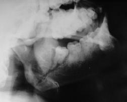 cirurgião, a presença de um cisto ou tumor em torno de um terceiro molar impactado, medicamentos que possam prejudicar a força dos ossos, e exame préoperatório inadequado. (CANKAYA et al.