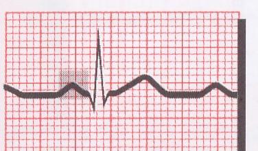 Interpretação do eletrocardiograma 5. Complexo eletrocardiográfico, onda P Representa a despolarização atrial. Localização: precede o complexo QRS.