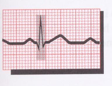 Interpretação do eletrocardiograma 5. Complexo eletrocardiográfico, QRS Representa a despolarização e a condução do impulso nos ventrículos. Localização: após o intervalo PR.