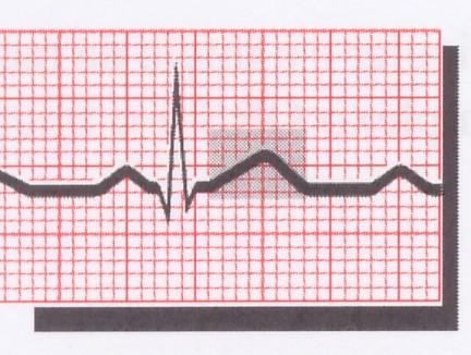 Interpretação do eletrocardiograma 5. Complexo eletrocardiográfico, onda T Representa o período refratário da repolarização ventricular. Localização: após o segmento ST.