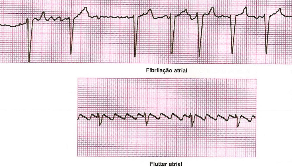 I- Critérios Eletrocardiográficos