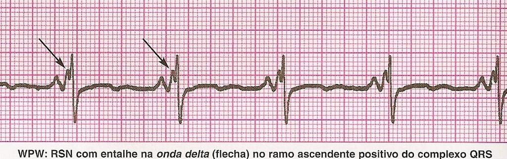 I- Critérios Eletrocardiográficos