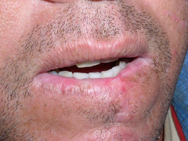 24 c) QA severa: endurecimento do lábio, perda do limite entre pele e semimucosa, ulcerações e crostas, além das alterações que ocorrem nos casos leve e moderado (Figura 3). Figura 3.