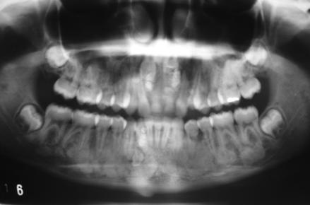 Solicitou-se radiografia panorâmica, que evidenciou a presença de odontomas compostos múltiplos e possíveis osteomas na mandíbula e maxila. (FIG.2)