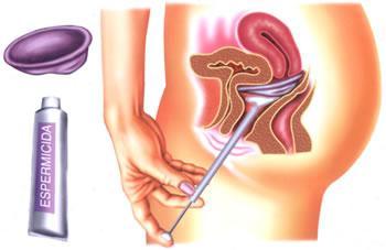 Métodos Químicos Espermicidas Produtos químicos que podem ser apresentados sob a forma de