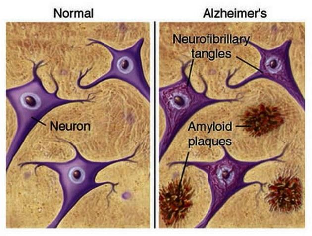 Doença de Alzheimer (DA) alterações biológicas nas proteínas tau e beta amiloide.