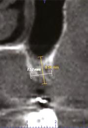 CONE MORSE REGIÃO DE MOLARES Essa região se caracteriza pela presença de um osso de menor qualidade (tipos III e IV), com uma fina cortical óssea e uma grande quantidade de osso esponjoso.