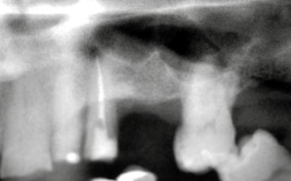 SEIO MAXILAR Os seios maxilares são cavidades ósseas localizadas no corpo da maxila, sendo os maiores dentre os seios paranasais.