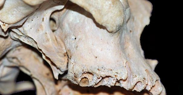 CONE MORSE A parede posterior é a região infratemporal, a porção interna do túber da maxila. Nessa região passa o nervo alveolar superior posterior.