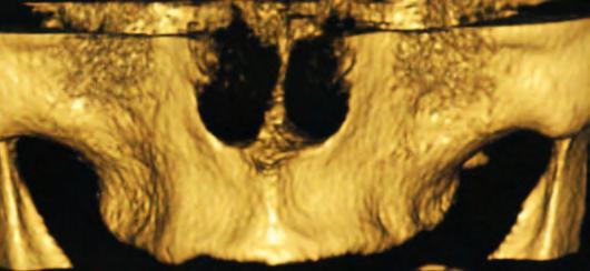 Mesmo uma simples instalação de implante após a exodontia pode tornar o resultado estético final desastroso se não houver um conhecimento apurado da anatomia da região.