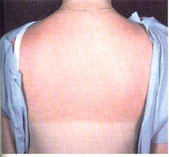 GRAU Atinge todas as camadas da pele: epiderme, derme e hipoderme.